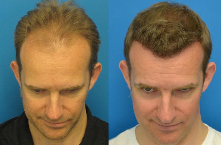 (+90 photo) Greffe générale de cheveux pour hommes: avis, photos avant et après