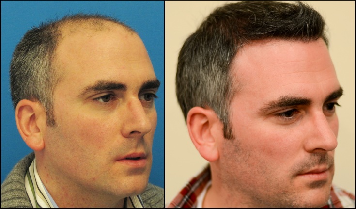 (+90 photo) Greffe générale de cheveux pour hommes: avis, photos avant et après